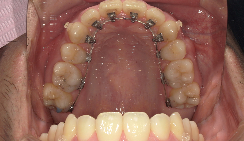 リンガルブラケット（舌側矯正）