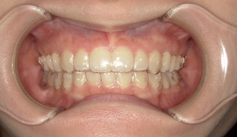 カスタムメイド型マウスピース矯正装置 (インビザライン)