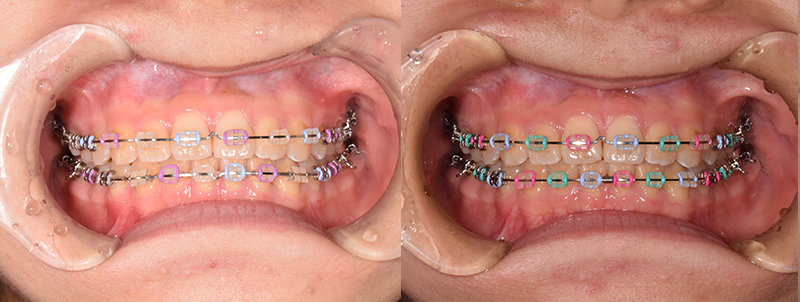 マウスピース矯正