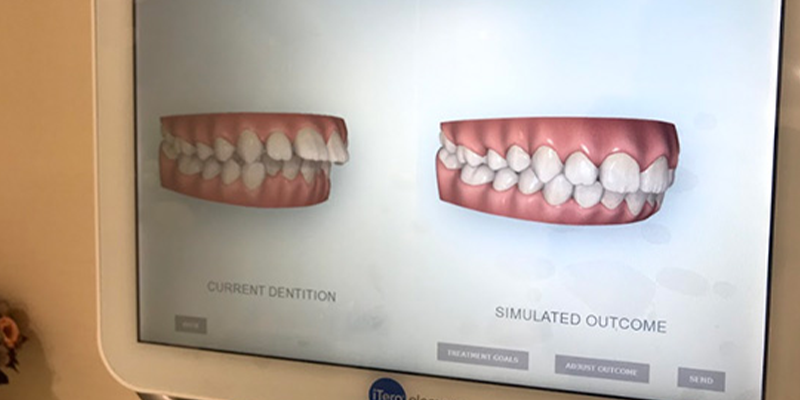 矯正治療後の歯並びがイメージできる