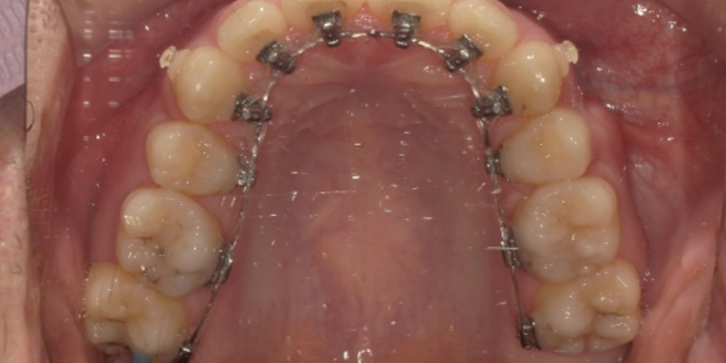 目立たないワイヤー矯正