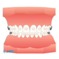 クリアブラケット