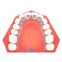 リンガルブラケット（舌側矯正）