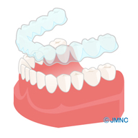 マウスピース矯正（カスタムメイド型マウスピース矯正）