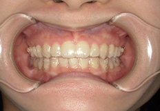 矯正器具のご紹介